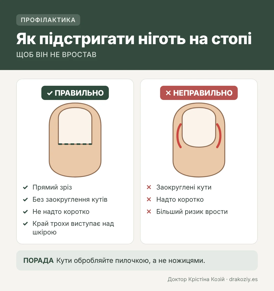 Як правильно підстригати ніготь на нозі: рівно, не заокруглюючи кутів і не надто коротко